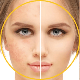 Dry Skin